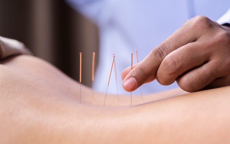 close up woman undergoing acupuncture treatment on back